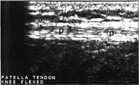 Image result for Ballottable Patella Sign