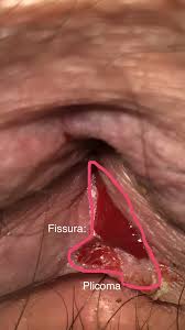 Fissura Anal Cronica Veja A Orientacao Errada No Tratamento Com Pomadas Inadequadas Associadas A Dilatacao Anal Descritos Em Caso Clinico Ilustrado Com Artigo Medico Videos E Fotos Educativas Com Link Para Site