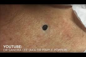 Последние твиты от dr pimple popper (@sandraleemd). The Reason Why You Are Obsessed With Pimple Popping Videos