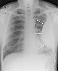Pleural effusion symptoms include shortness of breath or trouble breathing, chest pain, cough, fever, or chills. Treatment Of Complicated Pleural Effusions In 2013 Clinics In Chest Medicine