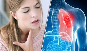 Lung cancer is the leading cause of cancer death and the second most common cancer among both men and women in the united states. Lung Cancer Symptoms Signs Of Tumour Include Hoarse Voice When Speaking Express Co Uk