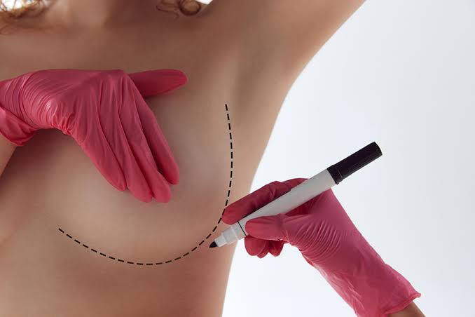 Breast Lift & Augmentation | Daniel Reichner, MD, FACS