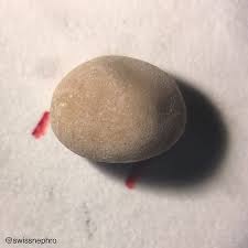 Smooth Kidney Stone Composed Of 80 Brushite Cahydrogenphosphate Dihydrate And 20 Whewellite Caoxalate Monohydrate U Nephrolithiasis Kidney Stones Renal