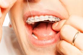 But once you get your braces, this seemingly simple habit becomes more complex. At Home Braces Care Follow This Guide For Healthy Teeth