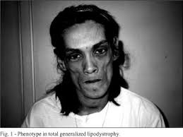 Patients with bscl present with a distinct phenotype since s. Scielo Brasil Cardiac Involvement In Total Generalized Lipodystrophy Berardinelli Seip Syndrome Cardiac Involvement In Total Generalized Lipodystrophy Berardinelli Seip Syndrome