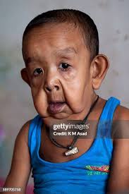 246 Progeria Stock Photos, High-Res Pictures, and Images