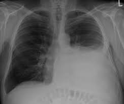 A pleural effusion is accumulation of excessive fluid in the pleural space, the potential space that surrounds each lung. Pleural Effusion Amboss