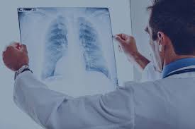 Getsearchinfo provides comprehensive information about your query. Mesothelioma Stages The 4 Stages Of Mesothelioma Explained