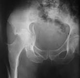 Image result for icd 9 code for intertrochanteric hip fracture