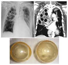 Necrotizing pneumonia refers to pneumonia characterized by the development of the necrosis within infected lung tissue. Flu Infections And Mrsa Combine Into Lethal Cocktail In Maryland