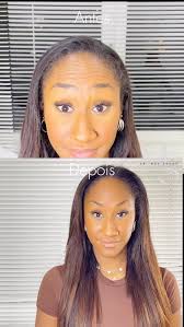 Mais um ótimo resultado! 💉,  ________________________________________________, Divulgação autorizada  pelo usuário. Cada ser humano tem características anatômicas e fisiológicas  únicas., Procedimento ...