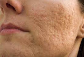 Your skin will not improve any faster, and your risk of developing side effects (such as redness, peeling, or pain) will increase. Topical Treatment Reduces Scar Formation In Acne