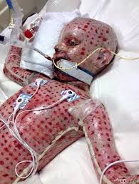 Sjs and ten exist on a spectrum of disease. A Child With Stevens Johnson Syndrome A Severe And Painful Skin Reaction That Is Treated In A Similar Way To Severe Burns The Patient In The Photo Apparently Recovered Fully Morbidreality