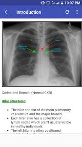 Possible causes, signs and symptoms, standard treatment options and means of care and support. Chest X Ray Based Cases For Android Apk Download