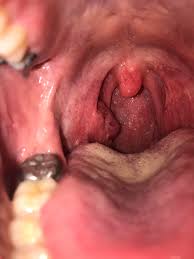 Throat cancer will start with initial symptoms such as a coughing, difficulty in swallowing and changes in the voice, which all are similar to the symptoms of cold and sore throat. Discovered This Three Weeks Ago When I Had A Sore Throat And Now I M Concerned About Tonsil Cancer Any Idea What Would Explain My Right Tonsil Looking Like This Tonsilstones