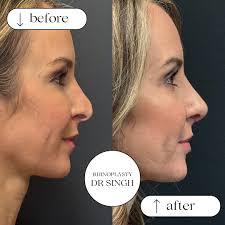 𝑹𝒆𝒗𝒊𝒔𝒊𝒐𝒏 𝑹𝒉𝒊𝒏𝒐𝒑𝒍𝒂𝒔𝒕𝒚 This amazing patient had a  rhinoplasty over 20 years ago and had subsequent trauma to the nose leaving  her with uneven nasal bones plus weakened and warped cartilage with