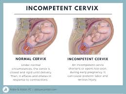 Image result for Friable Cervix