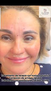 ❗️No permitas que las arrugas resten belleza a tu rostro.❗️🥰💎, La belleza  no es la ausencia de emociones 😊., Es la capacidad de gestionar el tiempo  ⏰️🥰., La botulinoterapia en NewMirEstetic, no trata ...