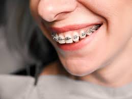 Expert Orthodontic Treatment with Grangerland Dental, TX | Fix Your Bite