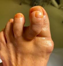 Image result for Hammer toe