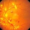 When a significant number of nerve fibers are damaged, blind. 1