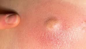 Herpes does not resemble ingrown hairs or boils. Cyst Vs Boil Identification Symptoms Causes And Treatments