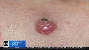 Image result for Merkel Cell Carcinoma