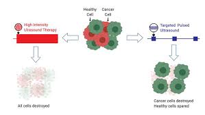 Colorectal cancer is expected to kill. New Ultrasound Treatment Kills Off Cancer Cells Science News For Students