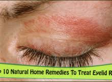 Contact dermatitis is a rash that crops up on your skin when you touch or have a reaction to a certain substance. Eyelid Dermatitis Archives Eyelids Lift Blog