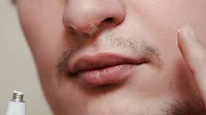 Solange bläschen oder geschwüre zu erkennen sind, ist ein herpes in jedem fall ansteckend. Nasenherpes Wenn Herpes Die Nase Befallt Zava Dred