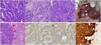 What are the treatments for colon cancer that has spread (metastatic cancer)? Development Of A Mouse Model For Sporadic And Metastatic Colon Tumors And Its Use In Assessing Drug Treatment Pnas