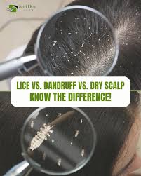 Image result for lice vs dandruff