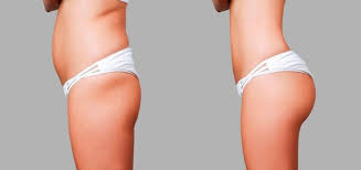 Découvrez nos prix de lipofilling des fesses tunisie. Prix D Un Lipofilling Des Fesses En Turquie Meilleureclinique
