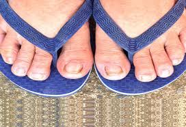 A fungal infection, such as yeast or a ringworm fungus, can cause toenails to turn yellow and thicken at how. Nail Fungus In Childern Causes Symptoms And Treatment