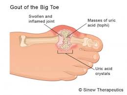 Image result for gout