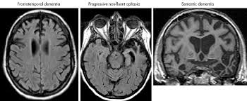 Within a year, you start to have thinking and memory problems that are similar to alzheimer's disease, along with changes in behavior. Axial Mri Scans Showing Abnormalities In The Spectrum Of Frontal Download Scientific Diagram