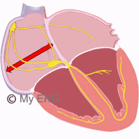 Crecimiento Auricular Derecho en el Electrocardiograma