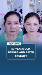 Effective Facelift Techniques for Youthful Skin