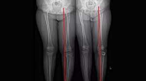 Genu Varum - Bowlegs in Children: What Physicians Need to Know | Children's  Hospital Los Angeles