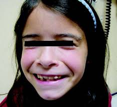 EARLY DIAGNOSIS OF THE UROFACIAL SYNDROME IS ESSENTIAL TO PREVENT  IRREVERSIBLE RENAL FAILURE