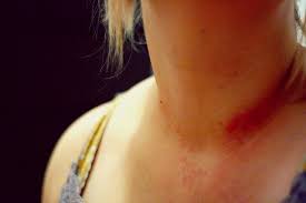 How To Treat Jewelry Allergies My Jewelry Boxes Your Information Source For Online Jewelry Shopping From Fashion Rings To Engagement Rings And Wedding Rings