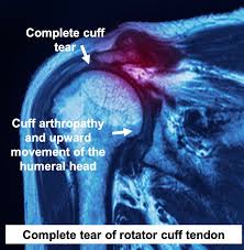 Image result for Shoulder MRI