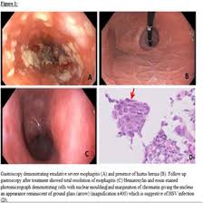 You are more likely to develop it if your immune system is weakened. Apdw 2018 E Poster Exhibitions Esophagus 2018 Journal Of Gastroenterology And Hepatology Wiley Online Library