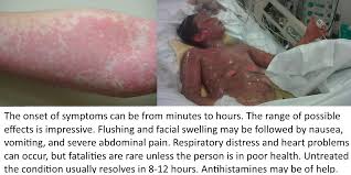 Image result for Scombroid Fish Poisoning