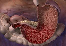 Gomes a1,2, skare tl1, prestes ma1, costa mda s1,2, petisco rd1, ramos gp1. Chronische Magenschleimhautentzundung Gastritis Ursachen Symptome Behandlung Medlexi De