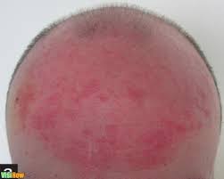 Chiggers are the larval form of a mite found primarily in the southeastern and middle regions of the united states. Stop Hair Loss Due To Hair Mites Visihow