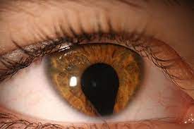 Check spelling or type a new query. Iris Coloboma Human Eye Eyes Iris