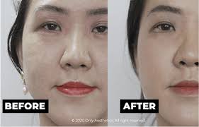 ONLY Home l Aesthetic Treatments In The Comfort Of Your Own Home!