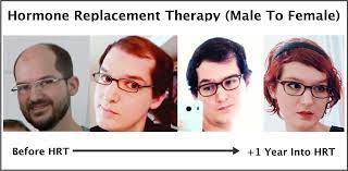 Pre hormones 19 years old. Exactly How Trans Hormone Replacement Therapy Regrows Hair Photos