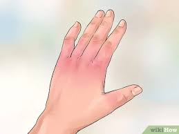 Frostbite is an injury caused by freezing of the skin and underlying tissues. How To Treat Frostbite 13 Steps With Pictures Wikihow